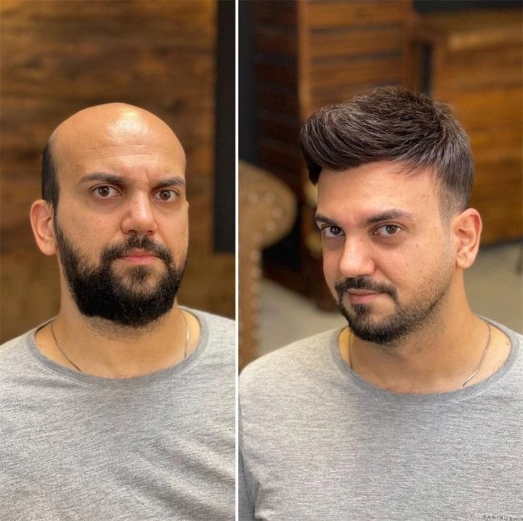 hair tapping